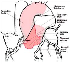 1) large ventricular septal defect (), which is a hole between the two ventricles or pumping chambers in the heart; Schematic Diagram Of The Anatomic Boundaries Of Bav Disease The Download Scientific Diagram