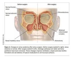 Image result for Sinusitis Prediction Rule