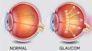 Ce Este Glaucomul Vitreum Centru Medical Oftalmologic