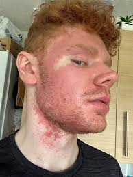 Man, 26, with 'acid burns' and 30 toilet trips a day told 'food poisoning'  is incurable disease