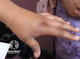 Image result for scabies on genitals