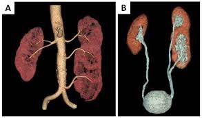 S Shaped Kidney A Rare Occurrence Of Supernumerary Kidney With Fusion Malrotation