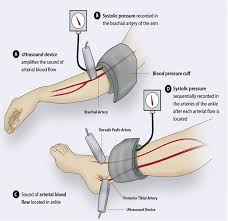 Measuring the ankle pressures place the cuff immediately proximal to the malleoli. Quantaflo A Reliable Alternative To Abi Testing And Ankle Brachial Index Machines By Simon Adle Medium