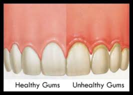 Healthy Vs Unhealthy Gums Healthy Tongue Gingivitis Dental Facts