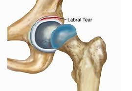 Image result for Snapping Hip