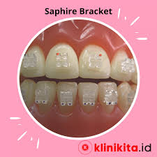 Harga braces india vs malaysia. Harga Gigi Palsu Klinik Swasta 2019