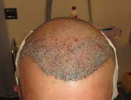 Find out where to post ads for free. Foto Trapianto Capelli Prima E Dopo Masullo Medical Group