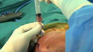 Image result for Septic Joint