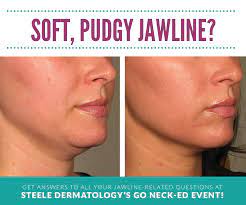 Place your fingers over each cheekbone gently lift the skin until taut open your mouth to form an elongated o; Best Anti Aging Treatments For Neck Chin And Jawline Jawline Good Jawline Face Tightening