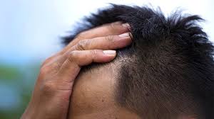 Check spelling or type a new query. Scalp Psoriasis Embarrassment And How To Cope Everyday Health