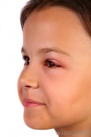 You could do the cold compress to make the swelling eyes get. What Are The Common Causes Of Eyelid Swelling With Pictures