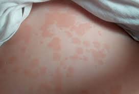 Semnele/petele respective sunt dureroase la atingere si parca imi vine sa le scarpin. Palme Rosii Si Mancarimi