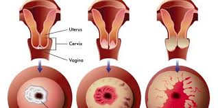 Apakah benar pil kb bisa tingkatkan kanker payudara dan kanker serviks pada perempuan? Cegah Kanker Rahim 18 Puskesmas Dibekali Alat Krioterapi
