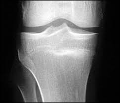 And we know that injured athletes have no higher priority than having a fast, full recovery and returning to their sports. Persistent Anterior Knee Pain Photo Quiz American Family Physician