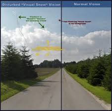 Visual snow is a visual disturbance occurring in individuals with normal ophthalmic findings. 14 Visual Snow Ideas Visual Snow Visual Snow