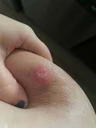 Help!! Nipple blister?!? | BabyCenter