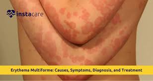Image result for Erythema Multiforme Causes