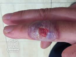 Image result for Anthrax