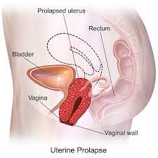Uterine prolapse - Wikipedia