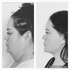 Snatched! This is one of my all time favorite patients. 45 y/o neck lift  face lift, 8weeks. Weight loss after age 35 creates extra skin everywhere,  we are seeing a ton of