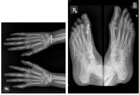 The rheumatoid community on reddit. Extraskeletal Manifestations In Rheumatoid Arthritis Clinical Cases Intechopen