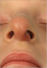 Nasal vestibulitis is not a serious condition, but in rare cases, it can cause severe complications if a person does not seek and receive treatment for it. Infections Of The Nose And Paranasal Sinuses Ento Key