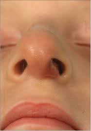 Infectious causes of such pain include impetigo, furuncles, and nasal vestibulitis (nv). Infections Of The Nose And Paranasal Sinuses Ento Key