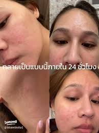 แชร์ประสบการณ์แพ้เมโส: สิ่งที่ต้องระวังก่อนฉีด