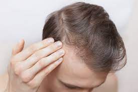 The pattern of hair loss from an iron deficiency is usually diffuse. Hair Loss And Ferritin Deficiency Trichology