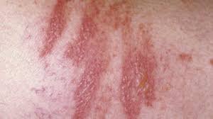 Image result for Photodermatitis