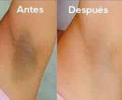 El blanqueamiento o aclaramiento de la zona genital, anal o la zona de  axilas es la decoloración de la zona oscura pigmentada alrededor de la  porción anal y de los genitales con