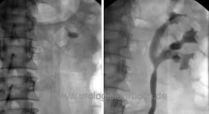 Image result for Nephrolithiasis