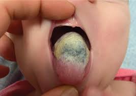 Image result for black hairy tongue symptoms