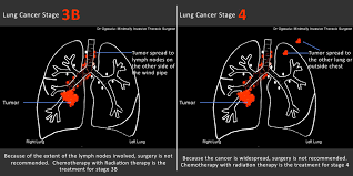 It is called stage 4 when tumor cells are most of the symptoms of lung cancer can be caused by any number of other illnesses, which is one reason why lung cancer is often not detected. When The Diagnosis Is Lung Cancer Now What Dr Ogwudu