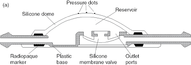 We did not find results for: Hydrocephalus Shunts Chapter 17 Adult Hydrocephalus