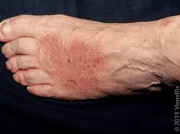 Image result for Atopic Dermatitis