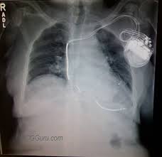 Cardiac failure, position of pacemaker, leads position. Bi Ventricular Pacemaker Icd Chest Xray Ecg Guru Instructor Resources