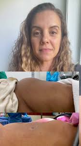 #greenscreensticker Women often ask me if their #fibroids are making them  look pregnant and the answer is…maybe. For those with large, bulky  fibroids, the uterus can sometimes be as large as someone 6 ...