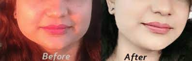 Fat transfer to correct vaser lipo of upper face including cheeks etc and to also revise a buccal fat removal 10 Best Ways To Reduce Cheek Fat In 10 Days Fast Thebeautymadness