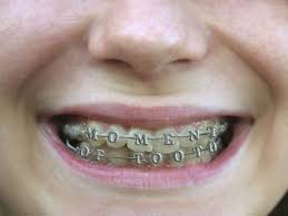 How long do you have to wear your rubber bands for braces? Once The Height Of Teen Embarrassment Braces Have Somehow Become Cool The Globe And Mail