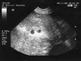 Discover sources 5 weeks 2 days ultrasound. 24 Ultraschallbild Ideen Ultraschallbild Ultraschall Baby Kinderzimmer Ideen