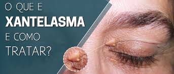 Image result for xantelasma