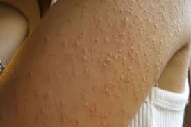 Image result for causes of body itching