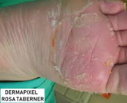 Dermatitis Plantar Juvenil A Mi Hijo Se Le Descaman Los Pies Familia Y Salud