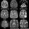 In the case of ms, this immune system malfunction destroys. 3