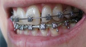 Nak pakai braces tapi tak tahu macam mana stepnya. 2 Tahun Tunggu Akhirnya Dah Cabut Braces Farah Dafri
