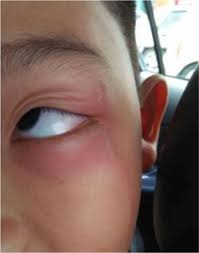 Walaupun hanya bersaiz kecil, tapi kesan gigitan tu aduh menyakitkan. Melecur Kalau Kena Gigit Ini Cara Merawat Kesan Gigitan Semut Charlie Lobak Merah