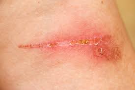 What are some effective ways to get rid of scabs? Picked Pimple Scab On Face Sinhala21 Blogspot Com
