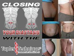 Closing Your Diastasis With The Tupler Technique Diastasis Diastasis Recti Female Fertility