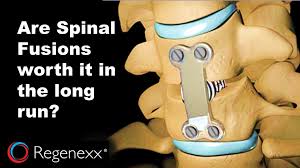 Spinal Fusion Is It Worth It